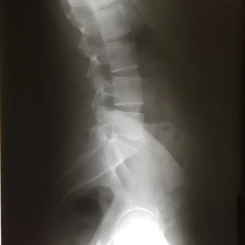 A lateral X-ray of the lumbar spine